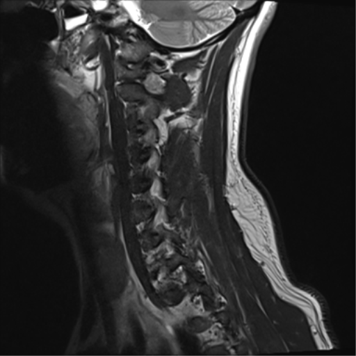File:Normal MRI cervical spine (infection protocol) (Radiopaedia 53916-60039 Sagittal T2 4).png