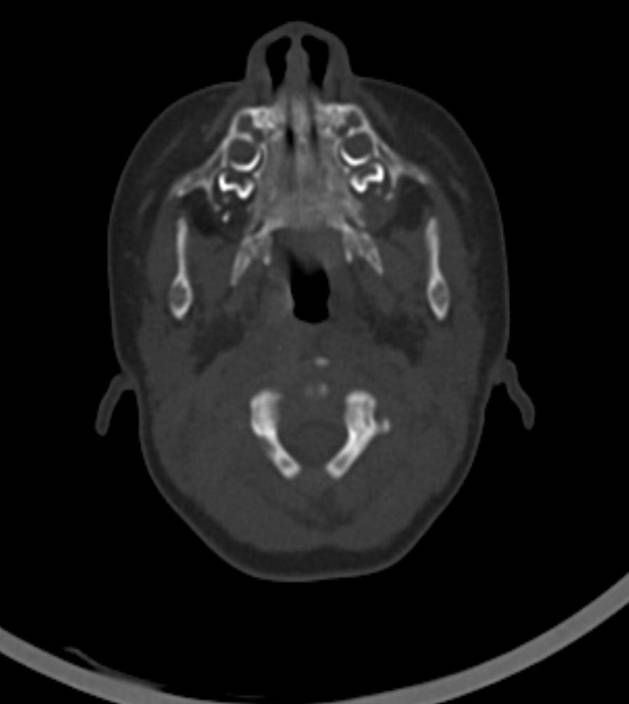 Normal brain CT - 2-month-old (Radiopaedia 53369-59350 Axial bone window 57).jpg