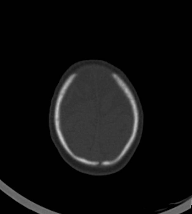 Normal brain CT - 2-month-old (Radiopaedia 53369-59350 Axial bone window 8).jpg