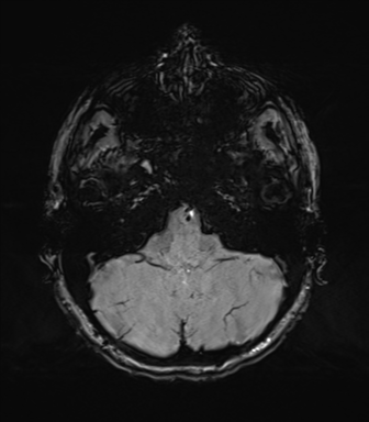 Normal brain MRI (TLE protocol) (Radiopaedia 40748-43405 Axial SWI 17).png