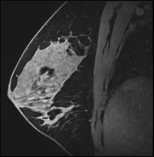 Normal breast MRI - dense breasts (Radiopaedia 80454-93850 I 102).jpg