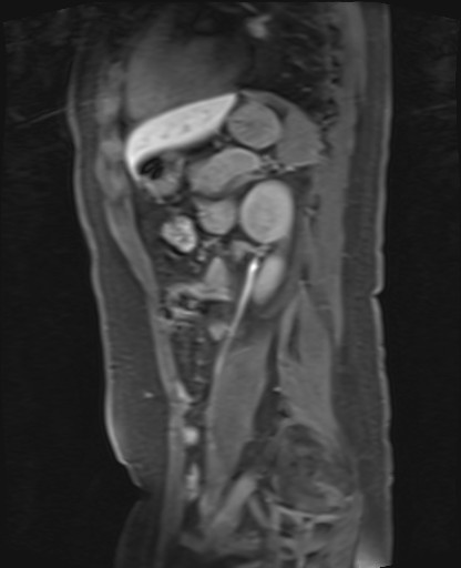 File:Normal hepatobiliary phase liver MRI (Radiopaedia 58968-66230 C 53).jpg