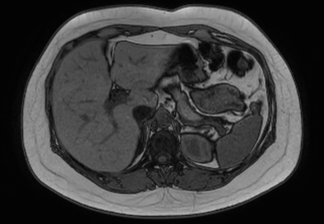 File:Normal liver MRI with Gadolinium (Radiopaedia 58913-66163 B 21).jpg