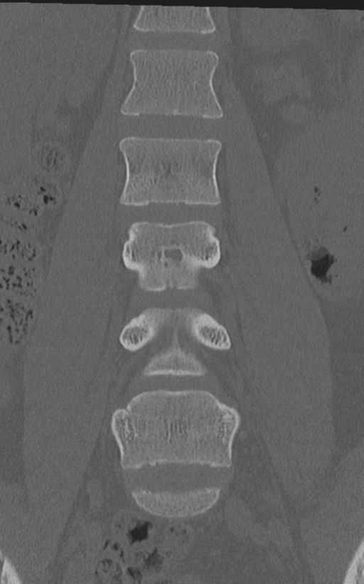 Normal lumbar spine CT (Radiopaedia 46533-50986 Coronal bone window 32).png