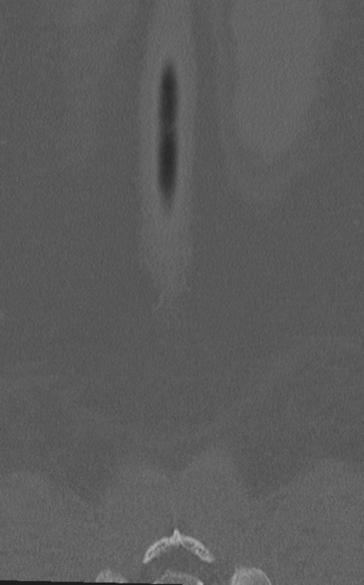 Normal lumbar spine CT (Radiopaedia 46533-50986 Coronal bone window 81).png