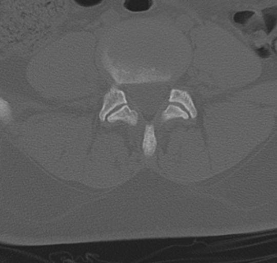 File:Normal lumbosacral CT (Radiopaedia 37923-39867 Axial bone window 69).png