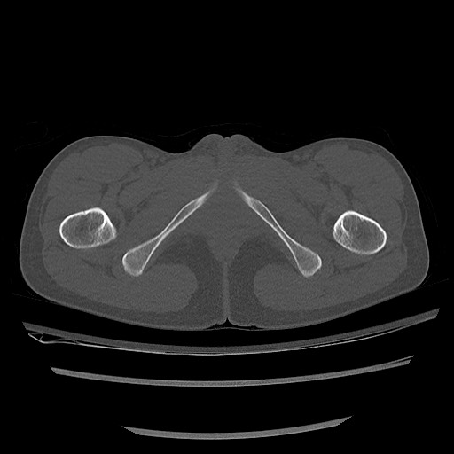 Normal pelvis CT (Radiopaedia 51471-57236 Axial bone window 96).jpg