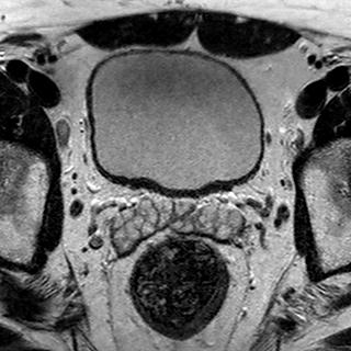 File:Normal prostate (MRI) (Radiopaedia 29986-30535 Axial T2 20).jpg