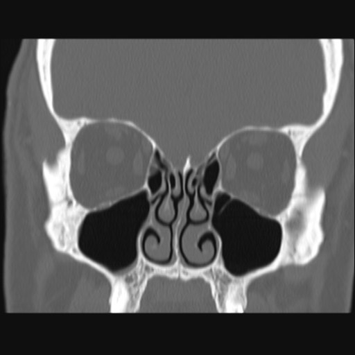 Normal sinus CT (annotated) (Radiopaedia 78917-91810 Coronal bone window 27).jpg
