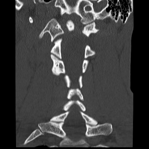 File:Normal trauma cervical spine (Radiopaedia 41017-43760 Coronal bone window 23).png