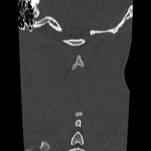 File:Normal trauma cervical spine (Radiopaedia 41017-43760 Coronal bone window 38).png
