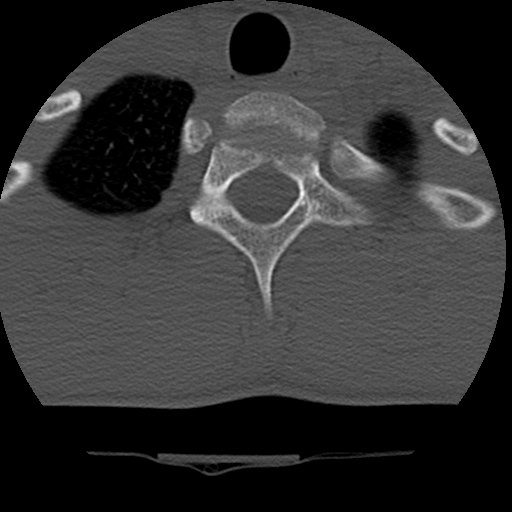 File:Normal trauma spine imaging (age 16) (Radiopaedia 45335-49358 Axial bone window 78).jpg