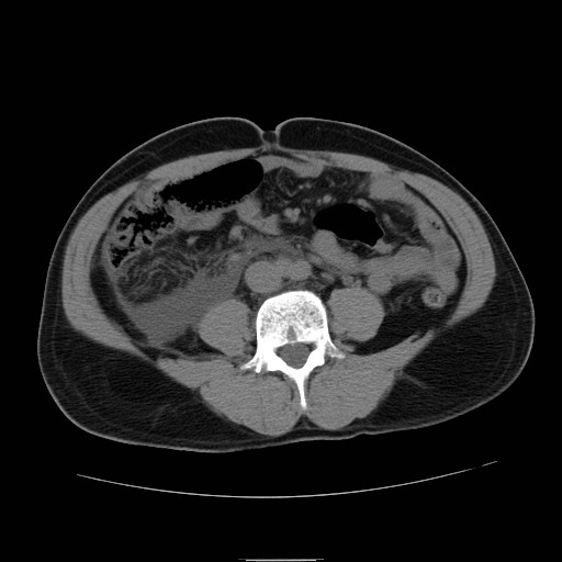 File:Obstructed kidney with perinephric urinoma (Radiopaedia 26889-27066 Axial non-contrast 36).jpg