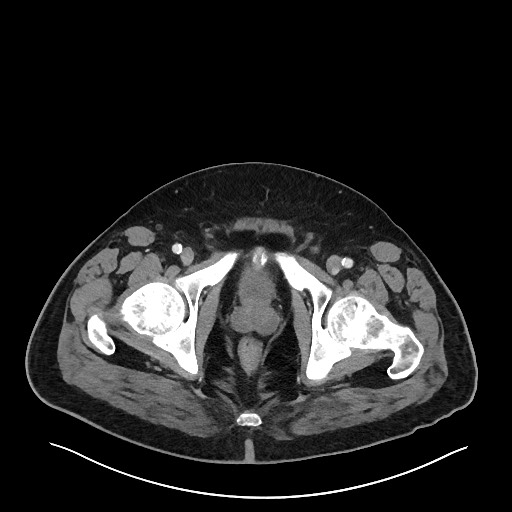 Obstructing sigmoid adenocarcinoma (Radiopaedia 58465-65619 A 158).jpg