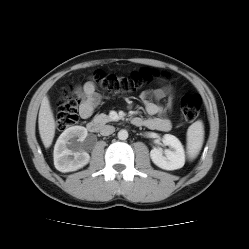 File:Obstructing ureteric calculus (Radiopaedia 18615-18514 B 24).jpg