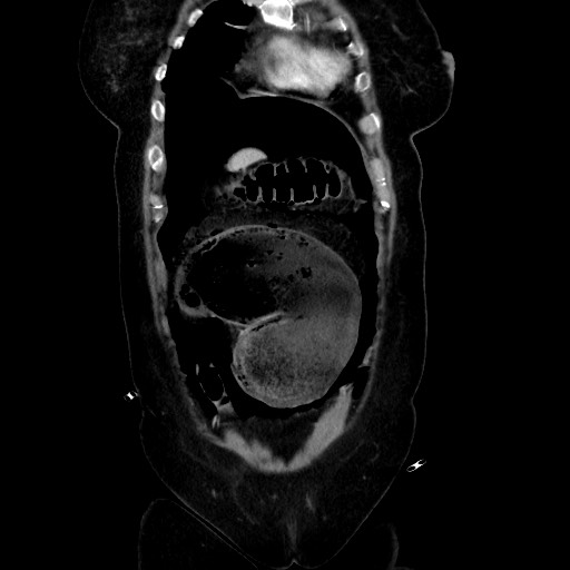 Obstructive distal colonic adenocarcinoma causing cecal perforation (Radiopaedia 86830-102989 C 56).jpg