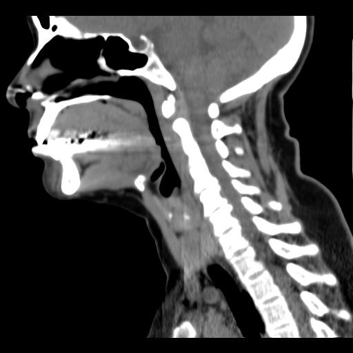File:Obstructive sleep apnea (CT evaluation) (Radiopaedia 24304-24582 C 35).jpg