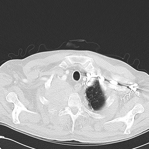 File:Obstructive superior vena cava tumor thrombus (Radiopaedia 28046-28306 Axial lung window 6).jpg