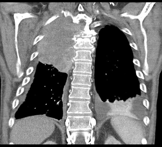 File:Obstructive superior vena cava tumor thrombus (Radiopaedia 28046-28306 B 39).jpg
