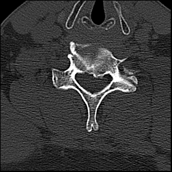 Occipital condyle fracture (type 1) (Radiopaedia 87670-104084 Axial bone window 65).jpg