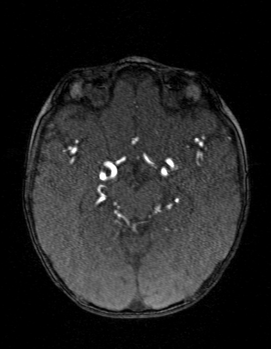 Occipital horn syndrome (Radiopaedia 14255-14129 MRA 70).jpg