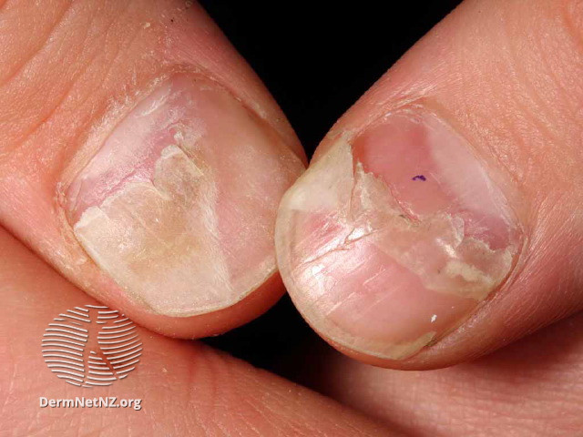 File:Onychomadesis following hand foot and mouth disease (DermNet NZ enteronailG).jpg