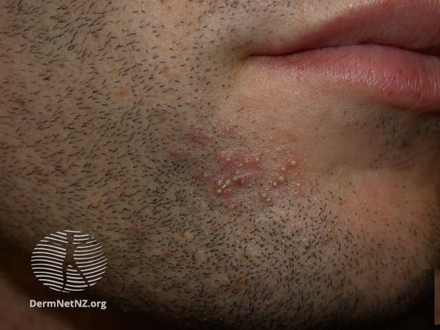 File:Superficial bacterial folliculitis (DermNet NZ acne-folliculitis3).jpg