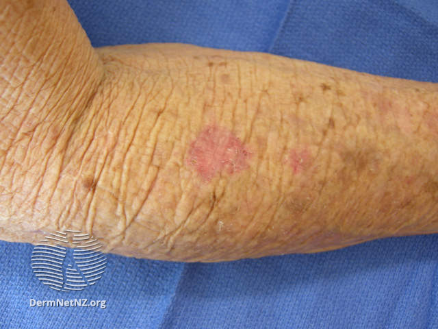 File:Superficial basal cell carcinoma, arm (DermNet NZ sbcc-arm-14-dn).jpg