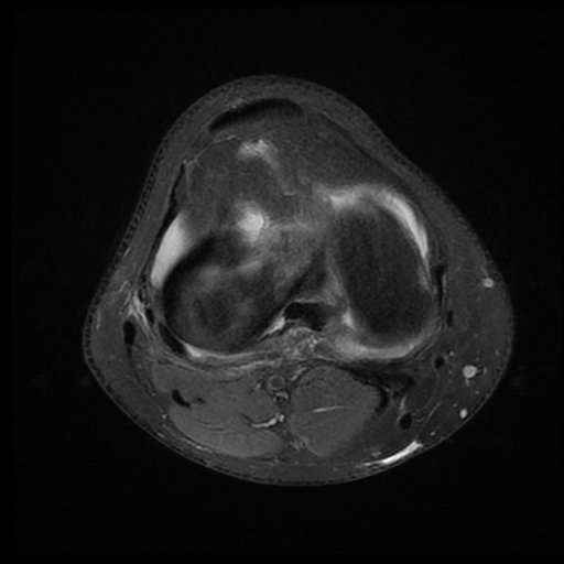 File:ACL acute full thickness tear - deep lateral femoral sulcus sign (Radiopaedia 38594-40740 Axial PD fat sat 16).jpg