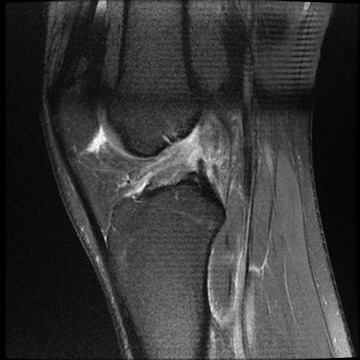 File:ACL acute full thickness tear - deep lateral femoral sulcus sign (Radiopaedia 38594-40740 Sagittal PD fat sat 12).jpg