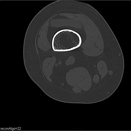 File:ACL avulsion fracture (Radiopaedia 33833-34994 Axial bone window 4).jpg