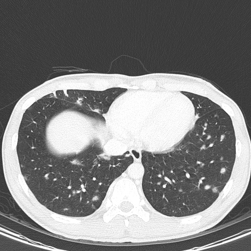 AIDS-related Kaposi sarcoma (Radiopaedia 85247-100811 Axial lung window 133).jpg