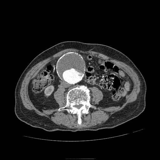 File:Abdominal aortic aneurysm (Radiopaedia 13341-13340 Axial C+ arterial phase 121).jpg