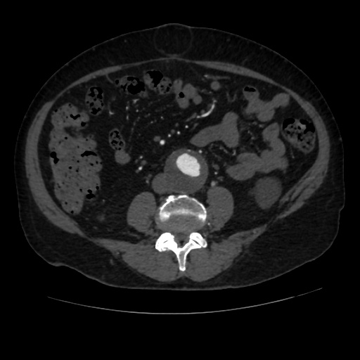 File:Abdominal aortic aneurysm (Radiopaedia 57318-64259 Axial C+ arterial phase 44).jpg