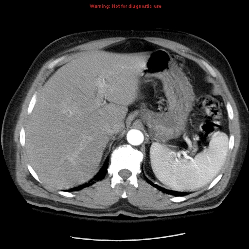 File:Abdominal aortic aneurysm (Radiopaedia 8190-9038 Axial C+ arterial phase 19).jpg
