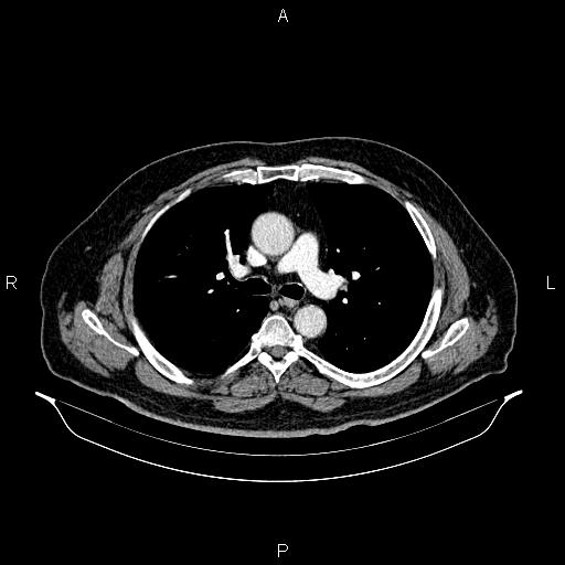 Abdominal aortic aneurysm (Radiopaedia 83094-97462 Axial renal cortical phase 33).jpg