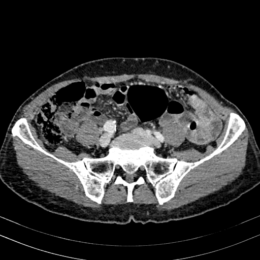 File:Abdominal aortic aneurysm (Radiopaedia 83581-98689 Axial C+ portal venous phase 80).jpg