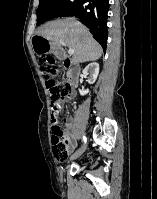 Abdominal aortic aneurysm (Radiopaedia 83581-98689 Sagittal C+ arterial phase 10).jpg