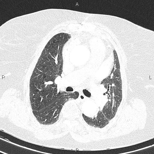 File:Abdominal aortic aneurysm (Radiopaedia 85063-100606 Axial lung window 31).jpg