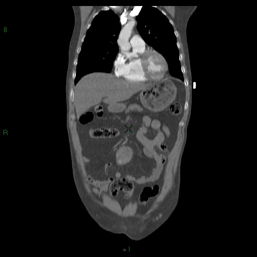 File:Abdominal aortic aneurysm rupture with aortocaval fistula (Radiopaedia 14897-14841 Coronal C+ arterial phase 19).jpg
