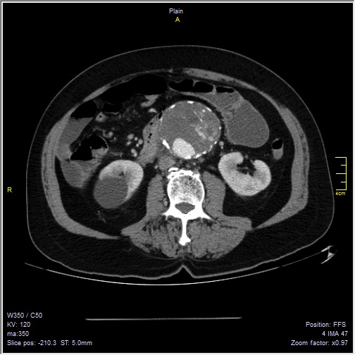 Abdominal aortic aneurysm with thrombus fissuration (Radiopaedia 47340-51926 Axial C+ arterial phase 31).jpg