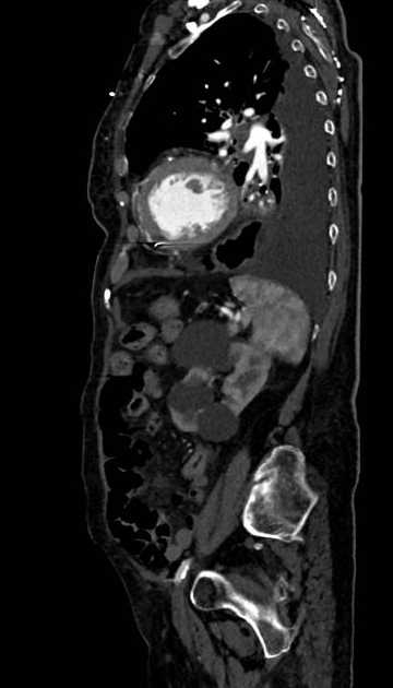 Abdominal aortic aneurysm with thrombus fissuration (Radiopaedia 73192-83919 Sagittal C+ arterial phase 36).jpg