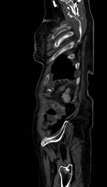 Abdominal aortic aneurysm with thrombus fissuration (Radiopaedia 73192-83919 Sagittal C+ arterial phase 7).jpg