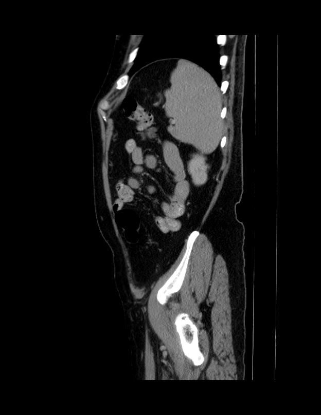 Abdominal lymphoma - with sandwich sign (Radiopaedia 53486-59492 Sagittal C+ portal venous phase 12).jpg