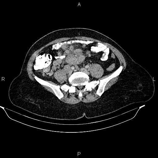 File:Abdominal lymphoma with sandwich sign (Radiopaedia 84378-99704 Axial C+ portal venous phase 40).jpg