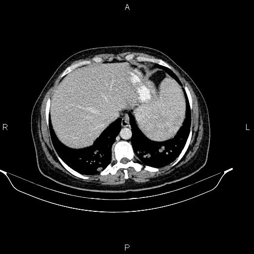 Abdominal lymphoma with sandwich sign (Radiopaedia 84378-99704 Axial C+ portal venous phase 8).jpg
