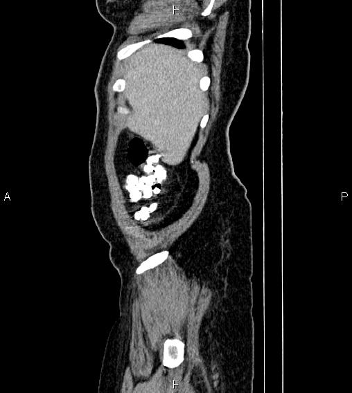 File:Abdominal lymphoma with sandwich sign (Radiopaedia 84378-99704 Sagittal C+ portal venous phase 1).jpg