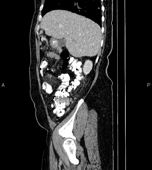Abdominal lymphoma with sandwich sign (Radiopaedia 84378-99704 Sagittal C+ portal venous phase 15).jpg