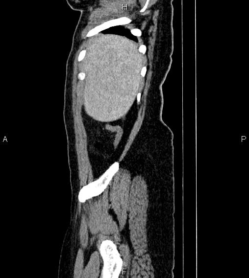 Abdominal lymphoma with sandwich sign (Radiopaedia 84378-99704 Sagittal C+ portal venous phase 86).jpg