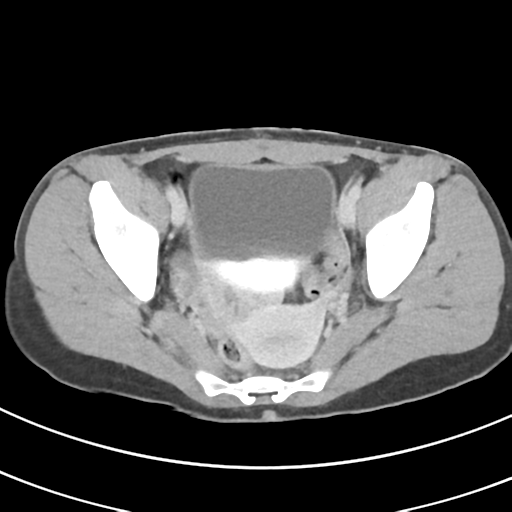 File:Abdominal multi-trauma - devascularised kidney and liver, spleen and pancreatic lacerations (Radiopaedia 34984-36486 Axial C+ delayed 69).png
